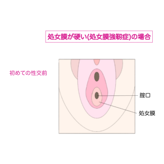 処女膜強靭症（処女膜が硬い）の場合の腟口と処女膜